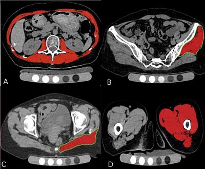 Comparison of Muscle Density in Middle-Aged and Older Chinese Adults Between a High-Altitude Area (Kunming) and a Low-Altitude Area (Beijing)